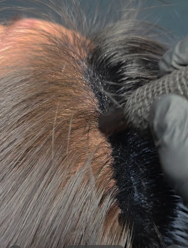 Hair Density