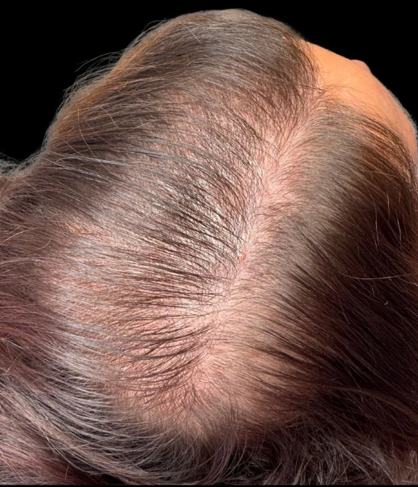 dun haar